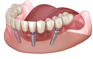Diagram of an implant denture to replace missing all teeth