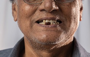 Man has missing teeth