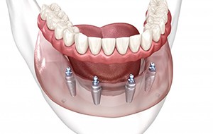 a 3D illustration of All-On-4 implants