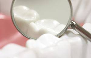 Tooth-colored fillings