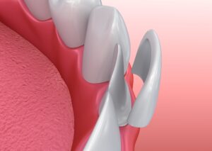 Model of porcelain veneer for a lower tooth