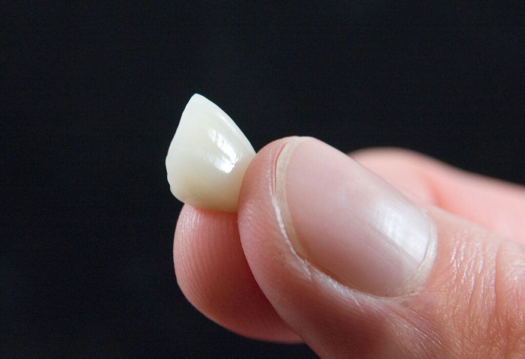 A man's hand holding a porcelain veneer.